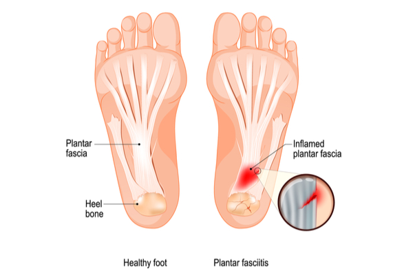 a diagram of plantar fasciitis